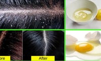 How to remove dandruff naturally?